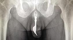 Radiografía del tenedor en el pene./ International Journal of Surgery Case Reports/