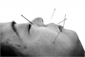 Un paciente chino recibe un tratamiento de acupuntura, mediante pinchazos en la cara. :: EFE/