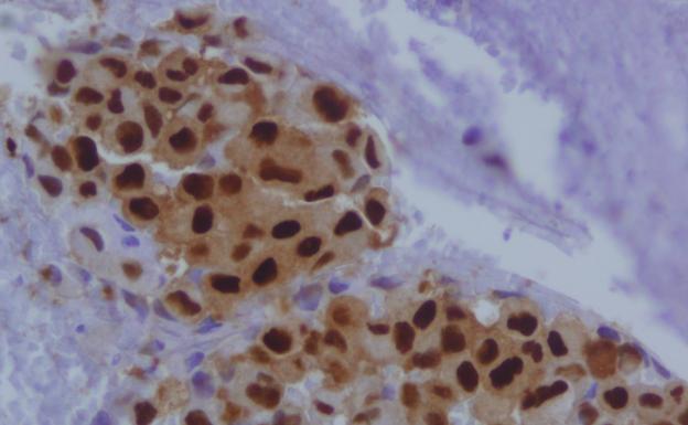 cáncer de próstata qué hacer restaurante